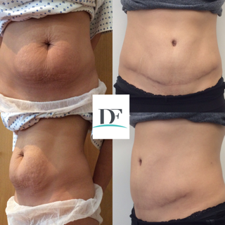 Abdominoplasty Surgery & Tummy Tuck Surgeons London